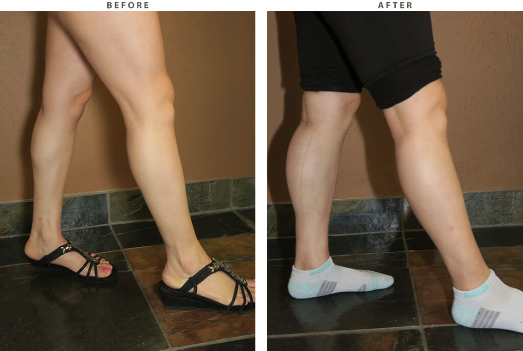 Calf Implants - Before and After Pictures