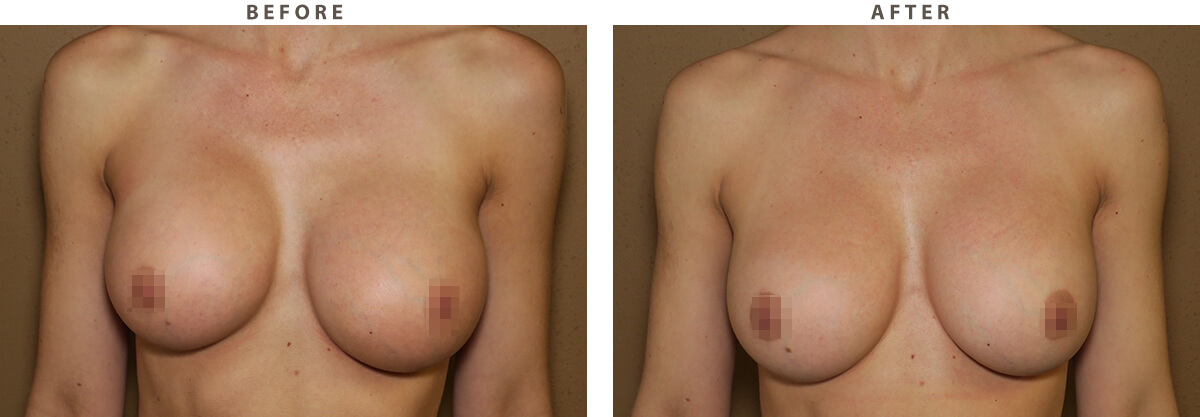 Capsular Contracture - Before and After Pictures