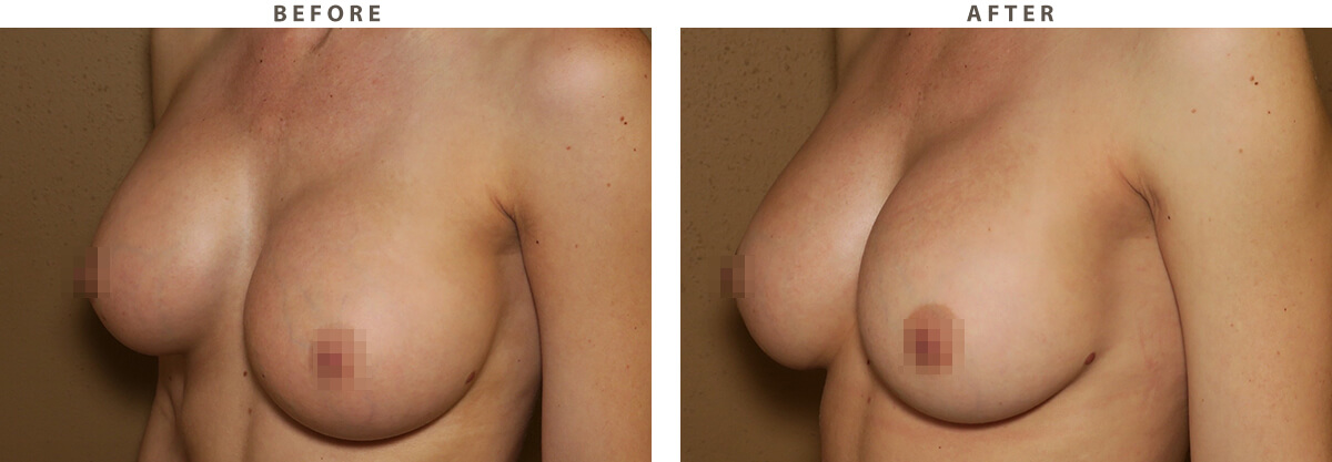 Capsular Contracture - Before and After Pictures