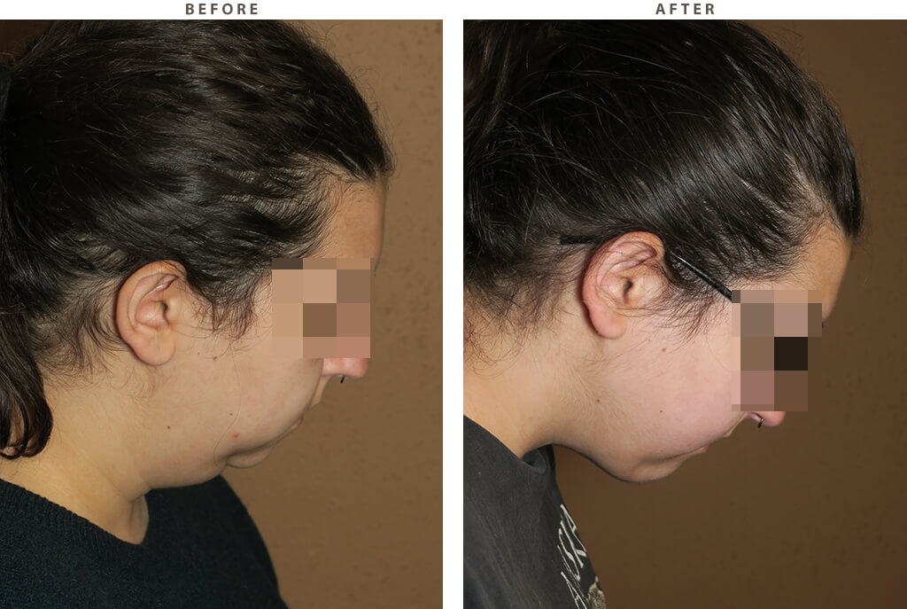 Chin augmentation - Before and After Pictures