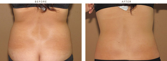 Cool Lipo - Laser liposuction Chicago