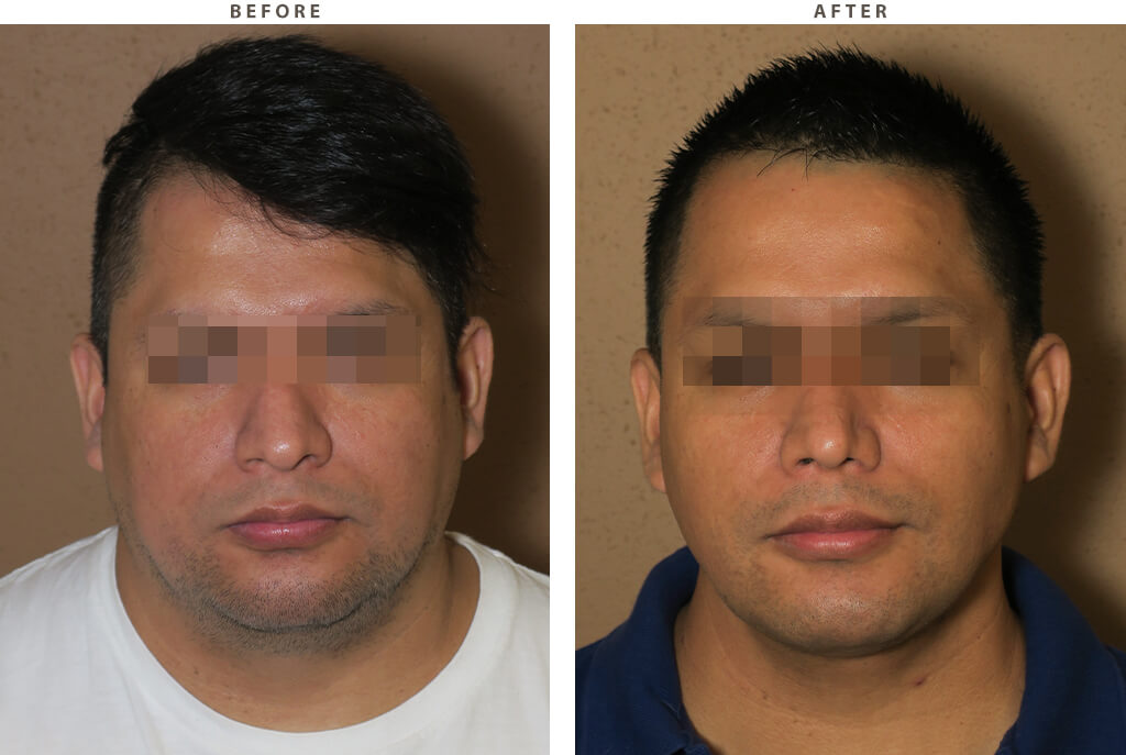 Face combo - Before and After Pictures