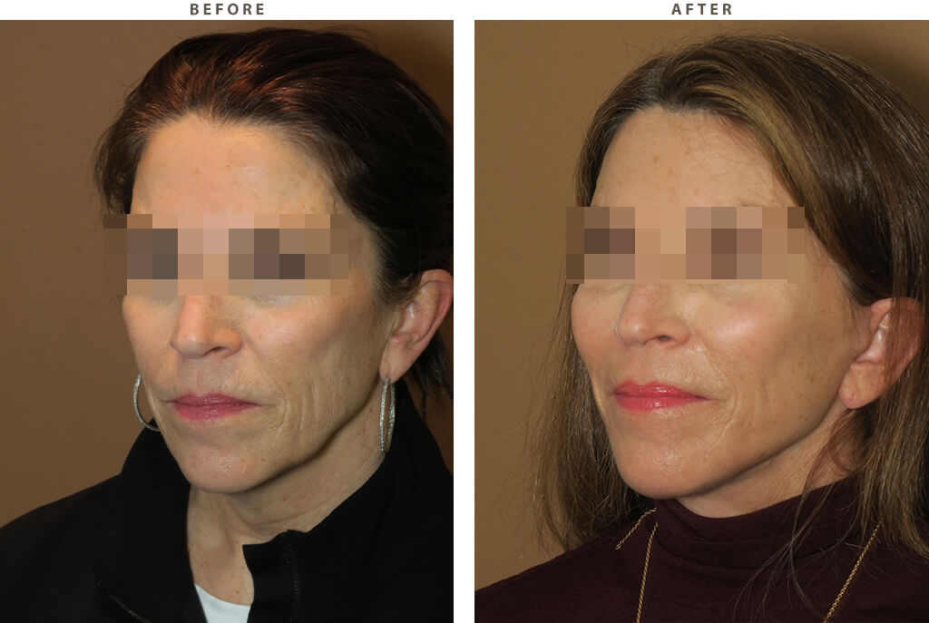 Face Lift - Before and After Pictures