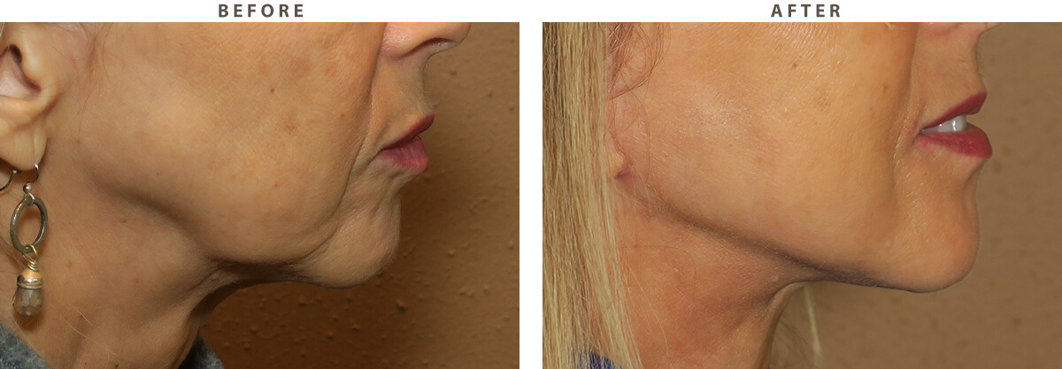 Facelift - Before and After Pictures