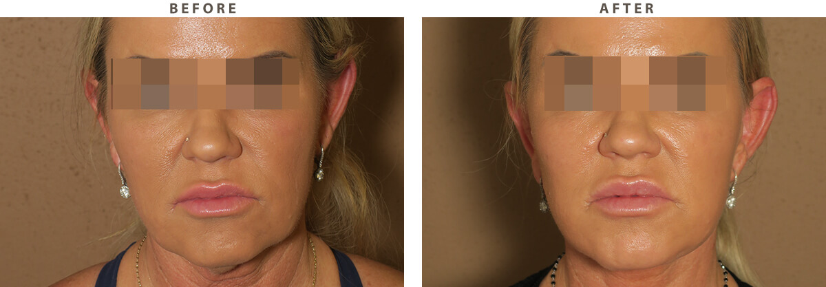Facelift - Before and After Pictures