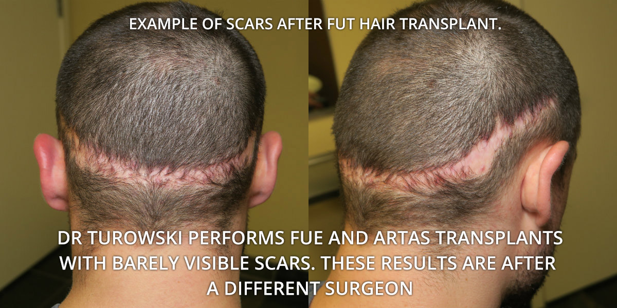 Fue Hair Transplant Before And After Photos Mind If Weblogs Navigateur