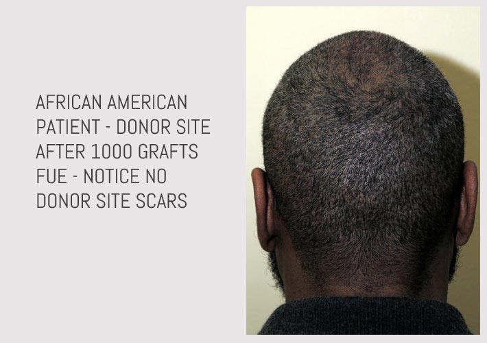 FUE hair transplant Chicago - African American FUE hair transplant Chicago - African American