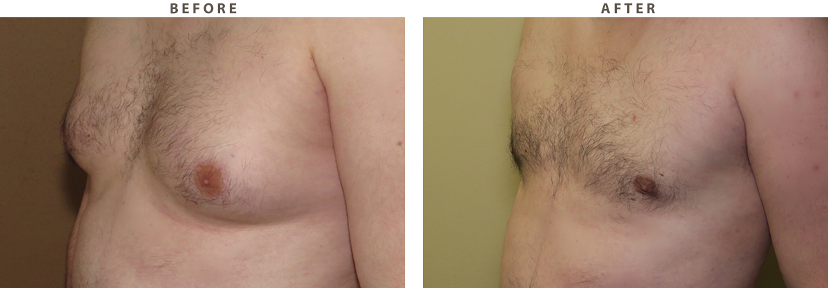 Gynecomastia - Before and After Pictures