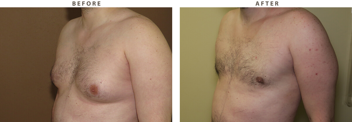 Gynecomastia - Before and After Pictures