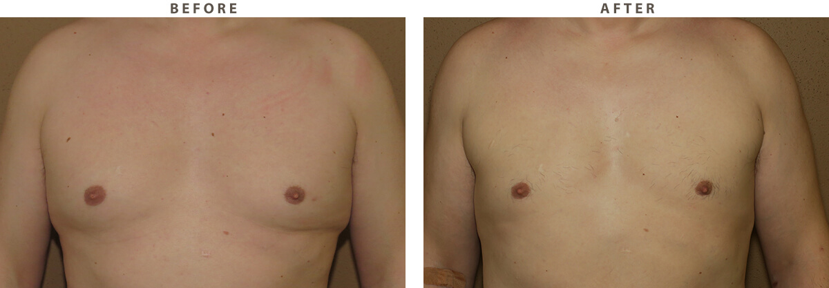 Gynecomastia- Before and After Pictures