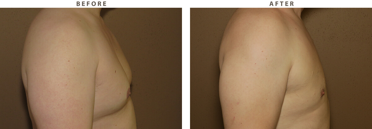 Gynecomastia- Before and After Pictures