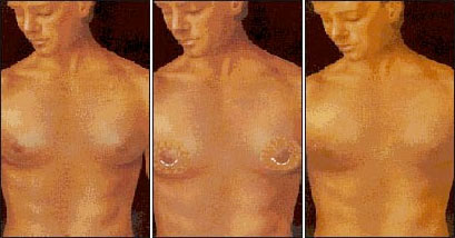 Gynecomastia Chicago