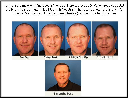 Hair Transplanatation Chicago