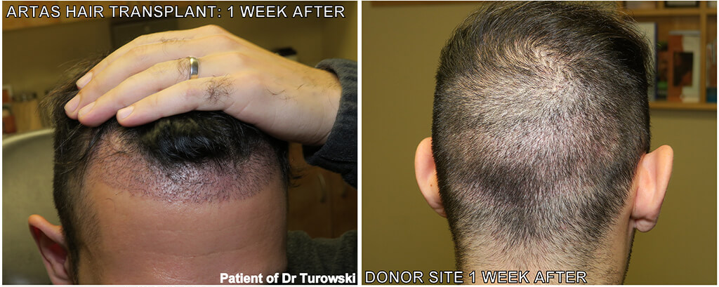 Hair Transplantation - Before and After Pictures