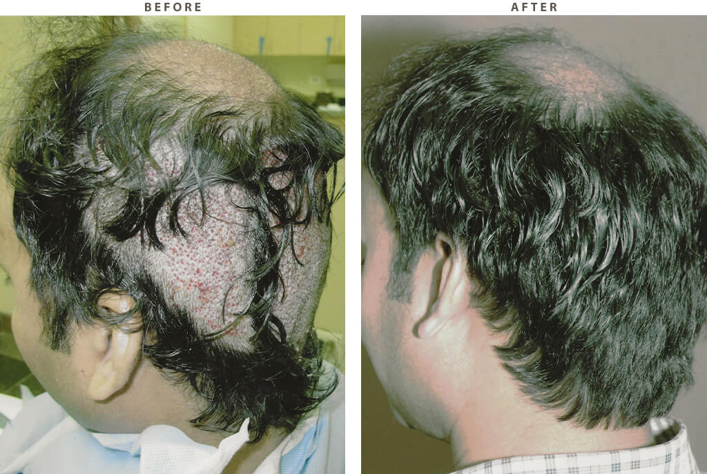 Hair Transplantation - Before and After Pictures