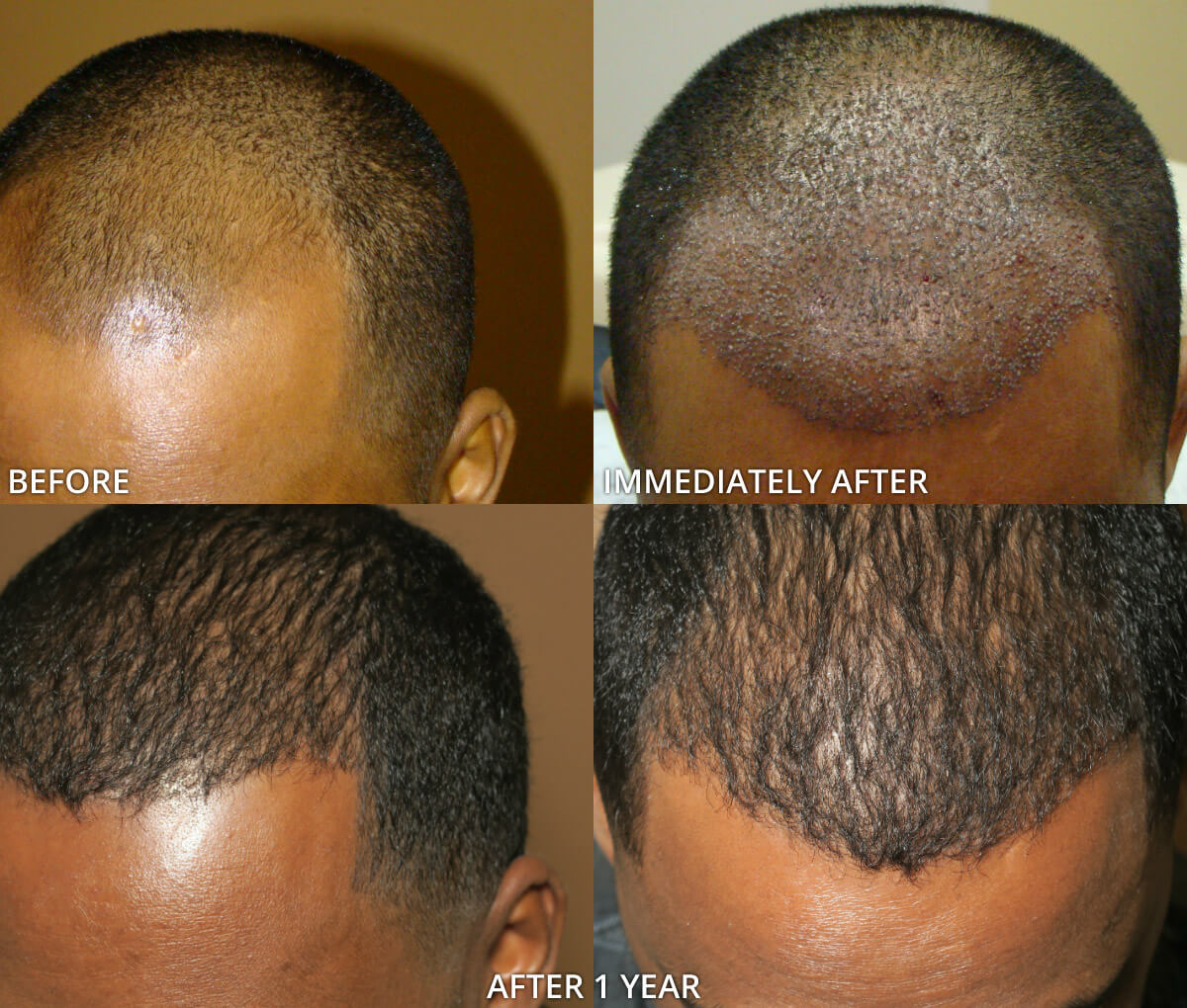 Grafts Hair Transplant Before And After Before And After Graft