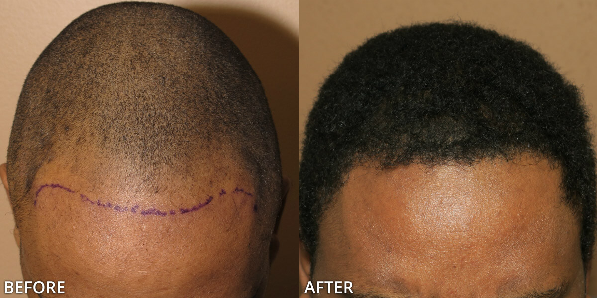 Fue Hair Transplantation Before And After Pictures Dr Turowski