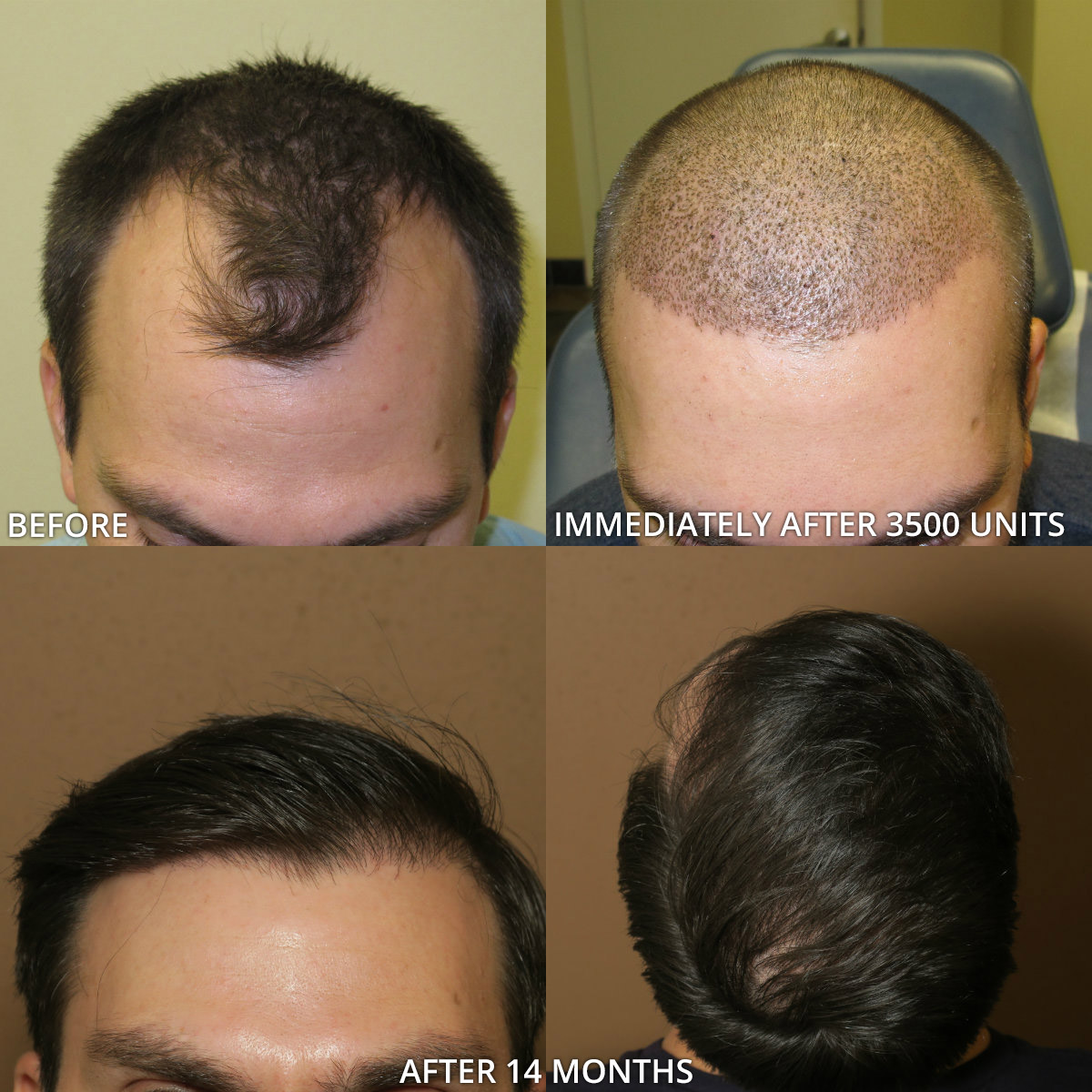месяц после пересадки волос фото