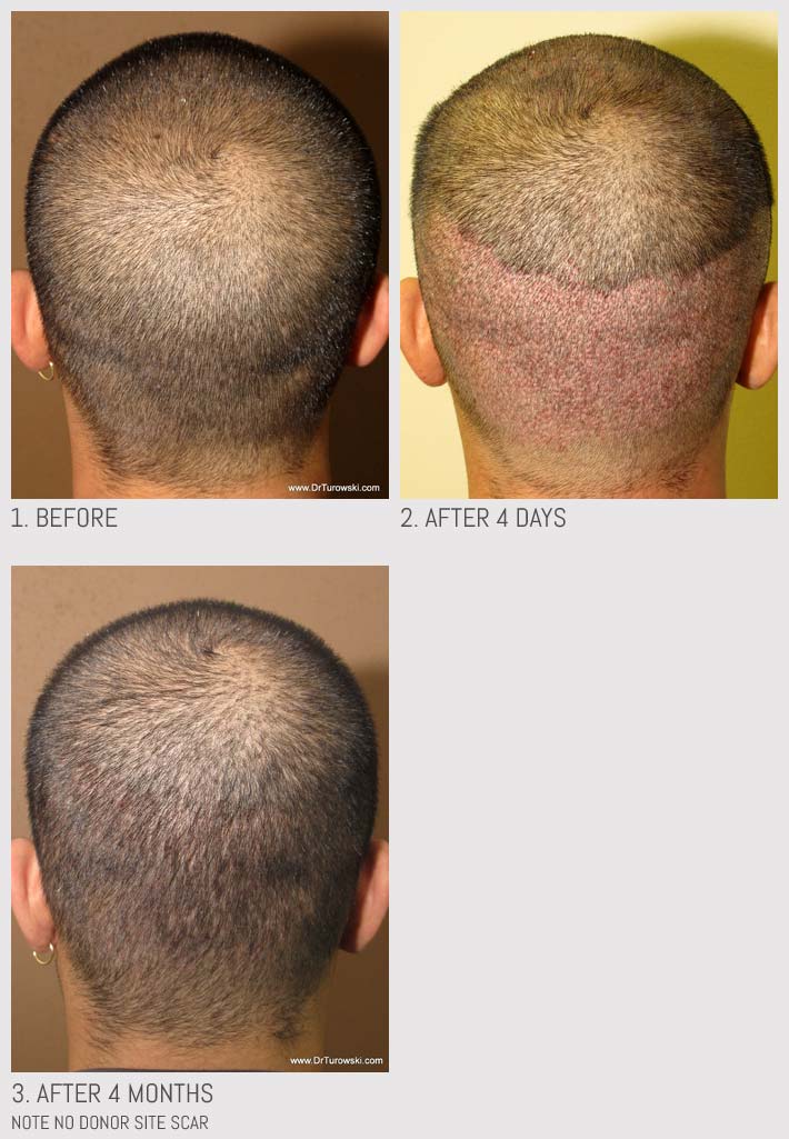 Hair Transplantation Chicago Hair Transplantation Chicago