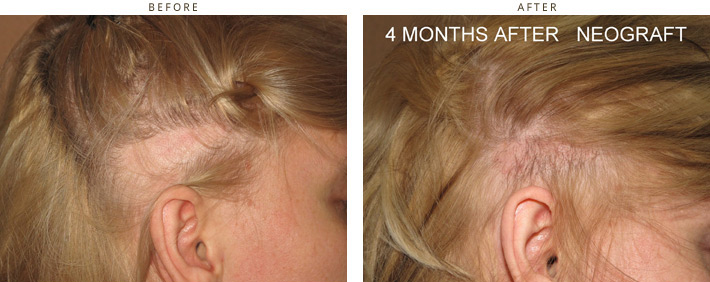 Hair transplant Chicago - 4 months after Hair transplant Chicago - 4 months after