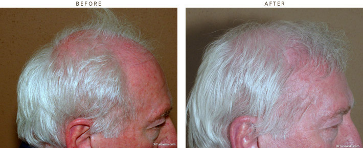 Hair Transplantation Chicago Hair Transplantation Chicago