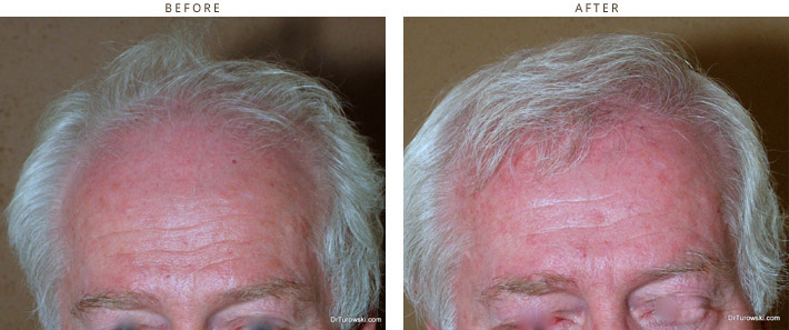 Hair Transplantation Chicago Hair Transplantation Chicago