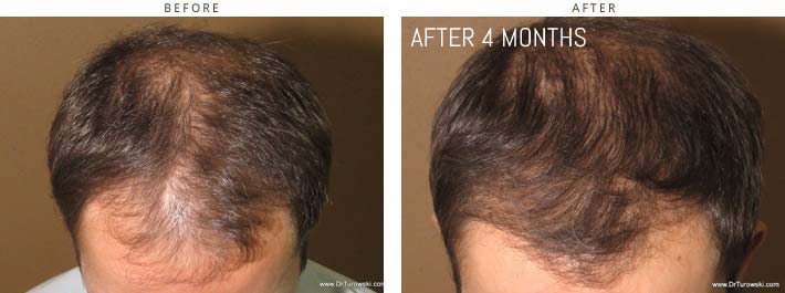 Hair Transplantation Chicago Hair Transplantation Chicago