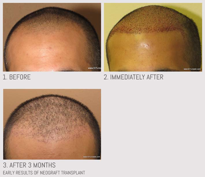 Hair Transplantation Chicago Hair Transplantation Chicago