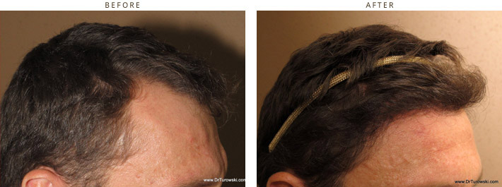 Hair Transplantation Chicago Hair Transplantation Chicago