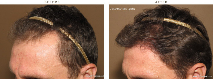 Hair Transplantation Chicago Hair Transplantation Chicago