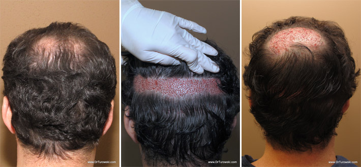 Hair Transplantation Chicago Hair Transplantation Chicago
