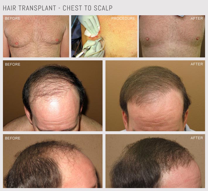 Hair Transplantation - Chest to Scalp