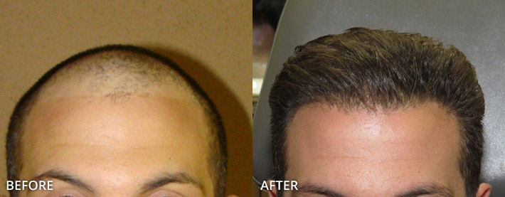 Przeszczep włosów (FUE) - zdjęcia przed i po zabiegu - Dr Turowski
