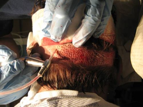 Hair Transplanatation Chicago