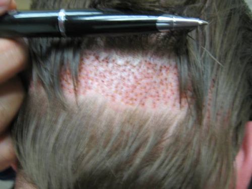Hair Transplanatation Chicago