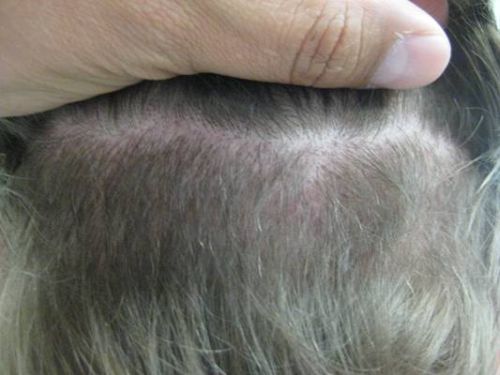 Hair Transplanatation Chicago