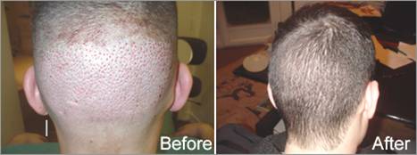 Hair Transplanatation Chicago