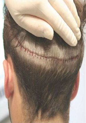 Hair Transplanatation
