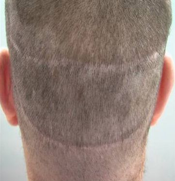 Hair Transplanatation