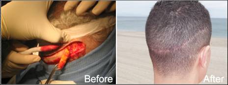 Hair Transplanatation