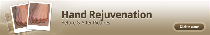 Hand Rejuvenation – Before and After Pictures