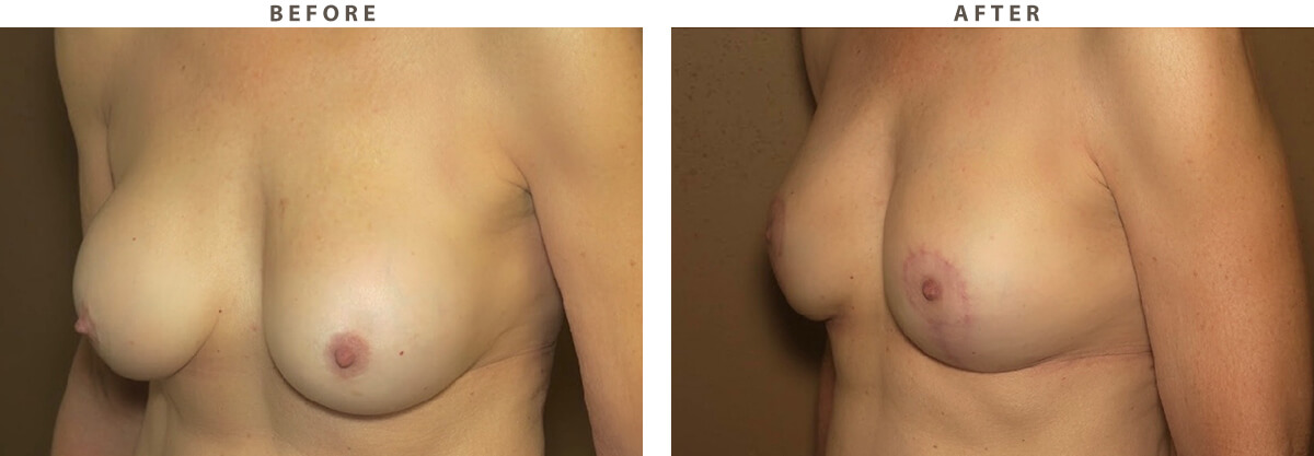 Breast Lift - Before and After Pictures