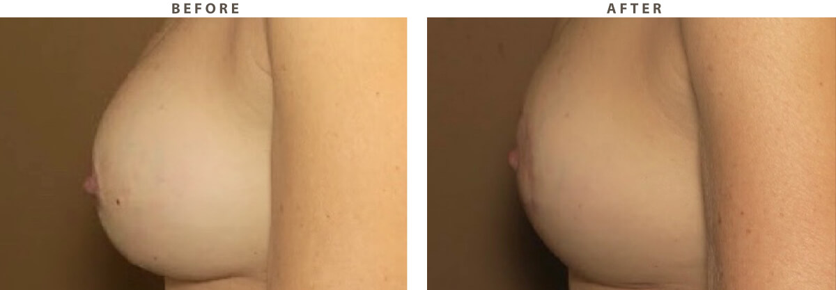 Breast Lift - Before and After Pictures