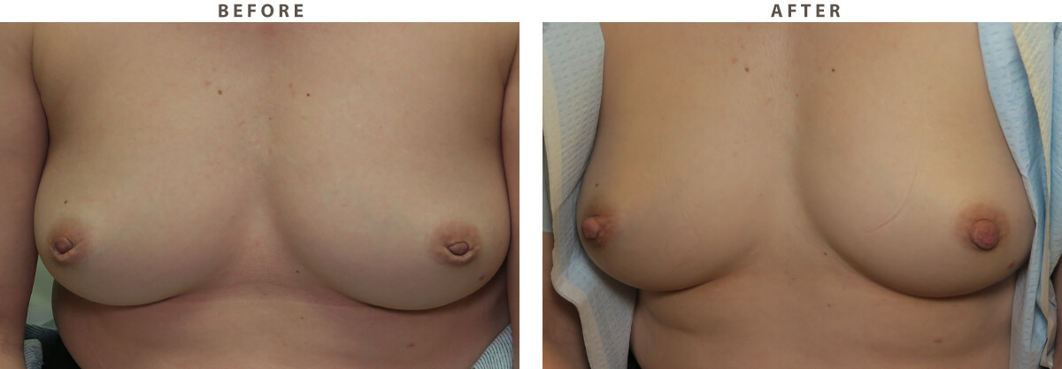 Inverted Nipple - Before and After Pictures