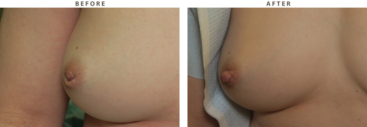 Inverted Nipple - Before and After Pictures