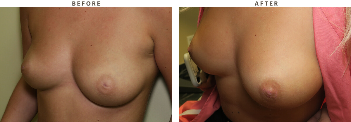 Inverted nipple correction - Before and After Pictures