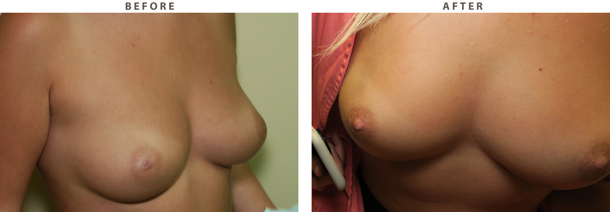 Inverted nipple correction - Before and After Pictures