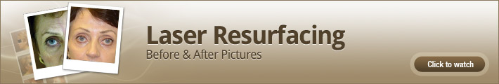 Laser resurfacing – Before and After Pictures