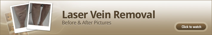 Laser Vein Removal – Before and After Pictures