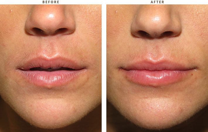 Lip lift - Before and After Pictures